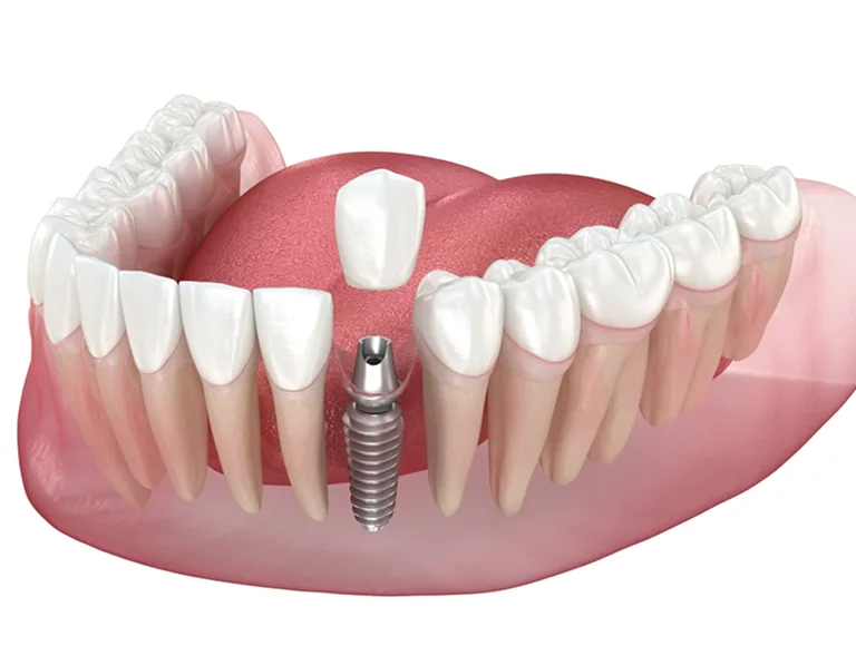Implant Restorations