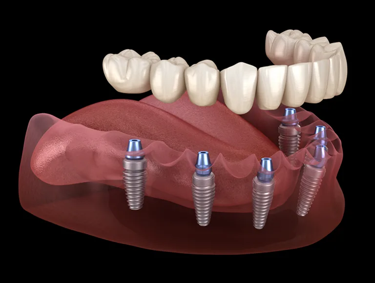 Full Arch Implants