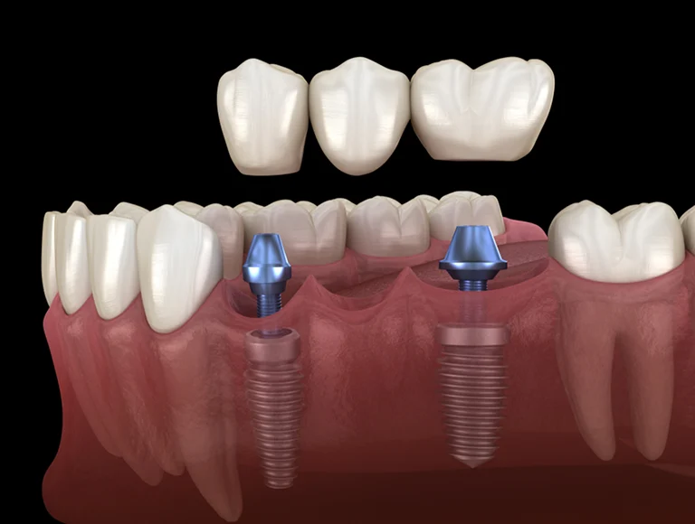 Implant-Supported Dentures