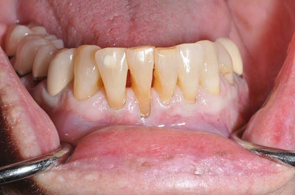 before gum recession treatment - Las Vegas, NV