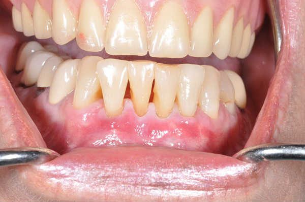 after gum recession treatment - Las Vegas, NV