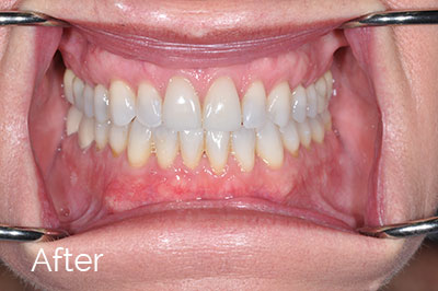 after image of gum recession correction - Las Vegas, NV