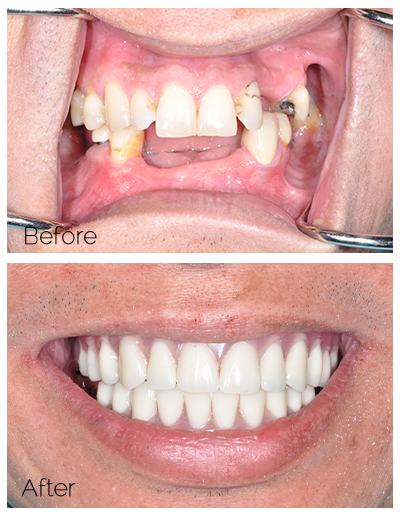 before and after dental implants - Las Vegas, NV