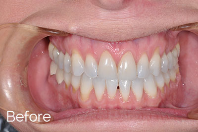 before image of gum recession correction - Las Vegas, NV