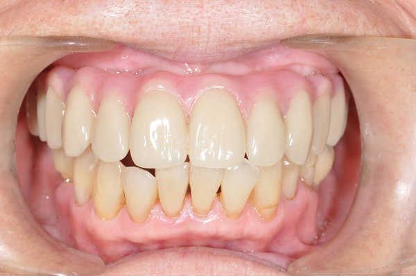 after cosmetic dentistry - Las Vegas, NV