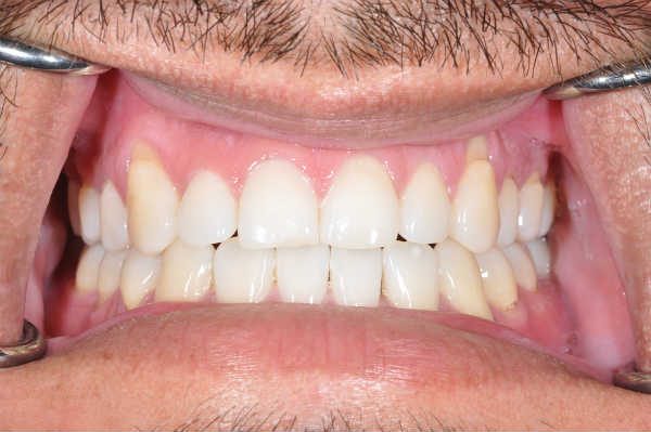 before gum recession treatment - Las Vegas, NV