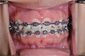 dental braces - Las Vegas, NV