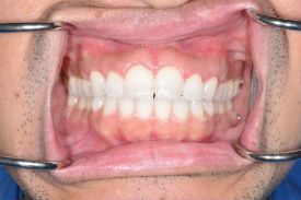 after cosmetic dentistry - Las Vegas, NV