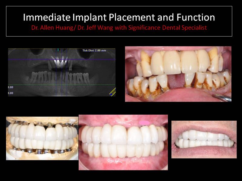 dental implants explained - Las Vegas, NV