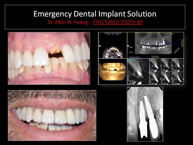 emergency implants - Las Vegas, NV