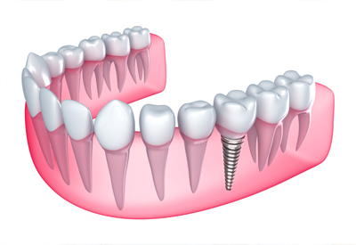 x-ray image of dental implant - Las Vegas, NV