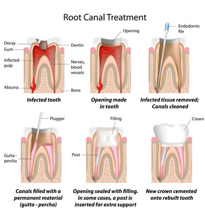 Diagram of root canal treatment - Las Vegas, NV