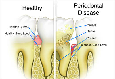 periodontal disease illustration - Las Vegas, NV