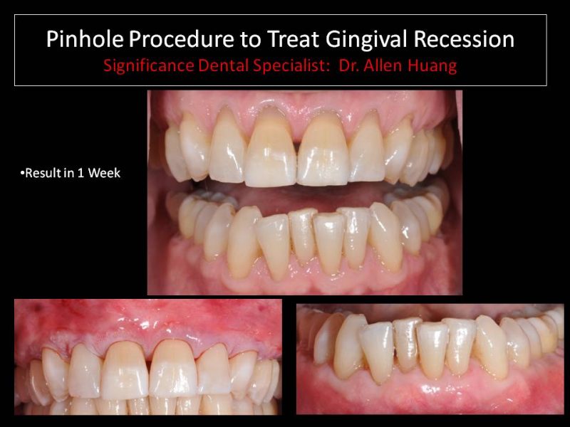 gingival recession - Las Vegas, NV