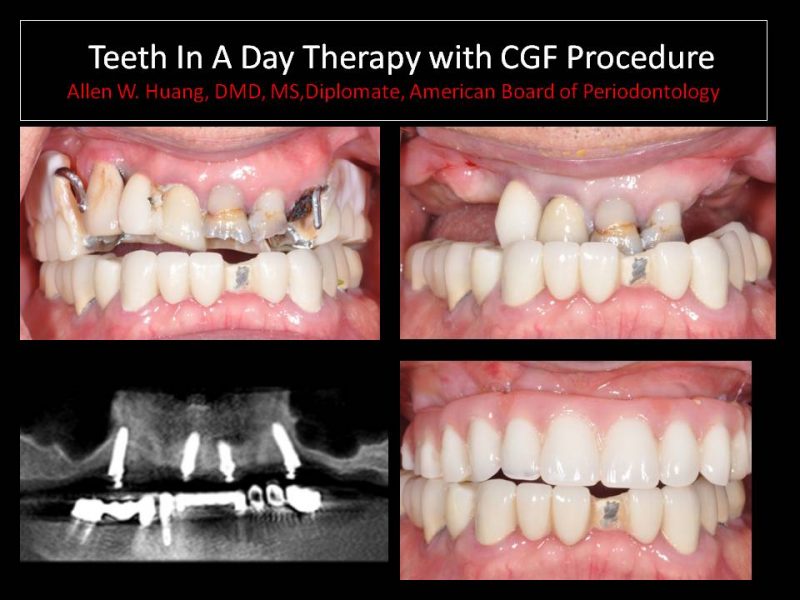 Teeth In A Day Case Study