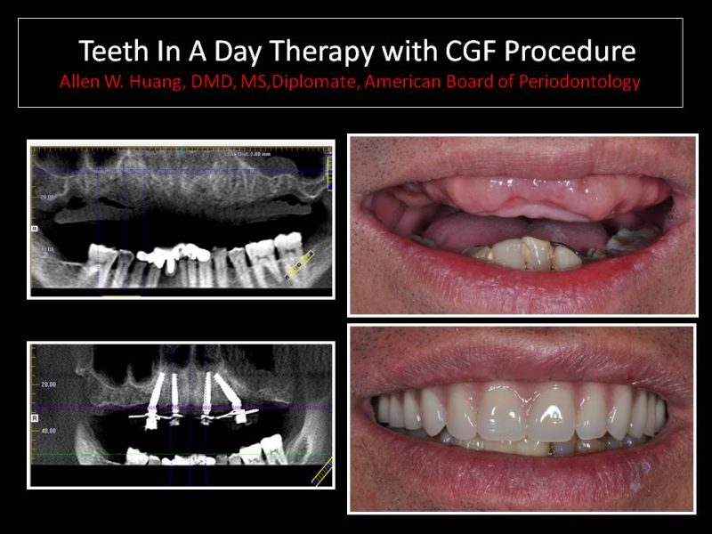 CGF procedure - Las Vegas, NV