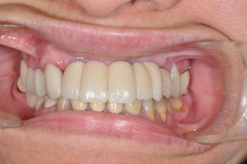 after dental implants - Las Vegas, NV