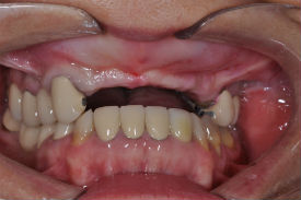 before dental implants - Las Vegas, NV
