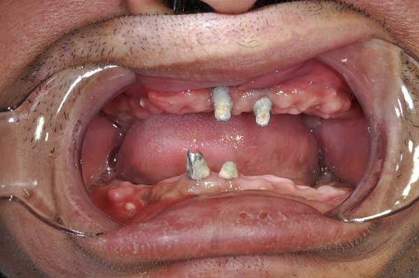 before dental implants - Las Vegas, NV