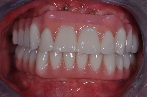 after dental implants - Las Vegas, NV