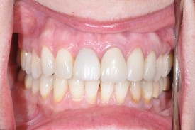 after dental implant - Las Vegas, NV