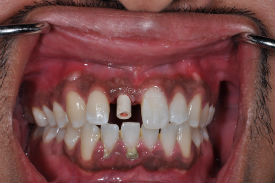 before dental implant - Las Vegas, NV