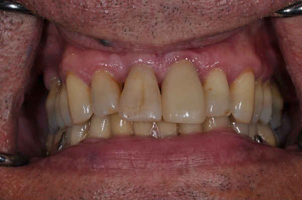 after dental implant - Las Vegas, NV